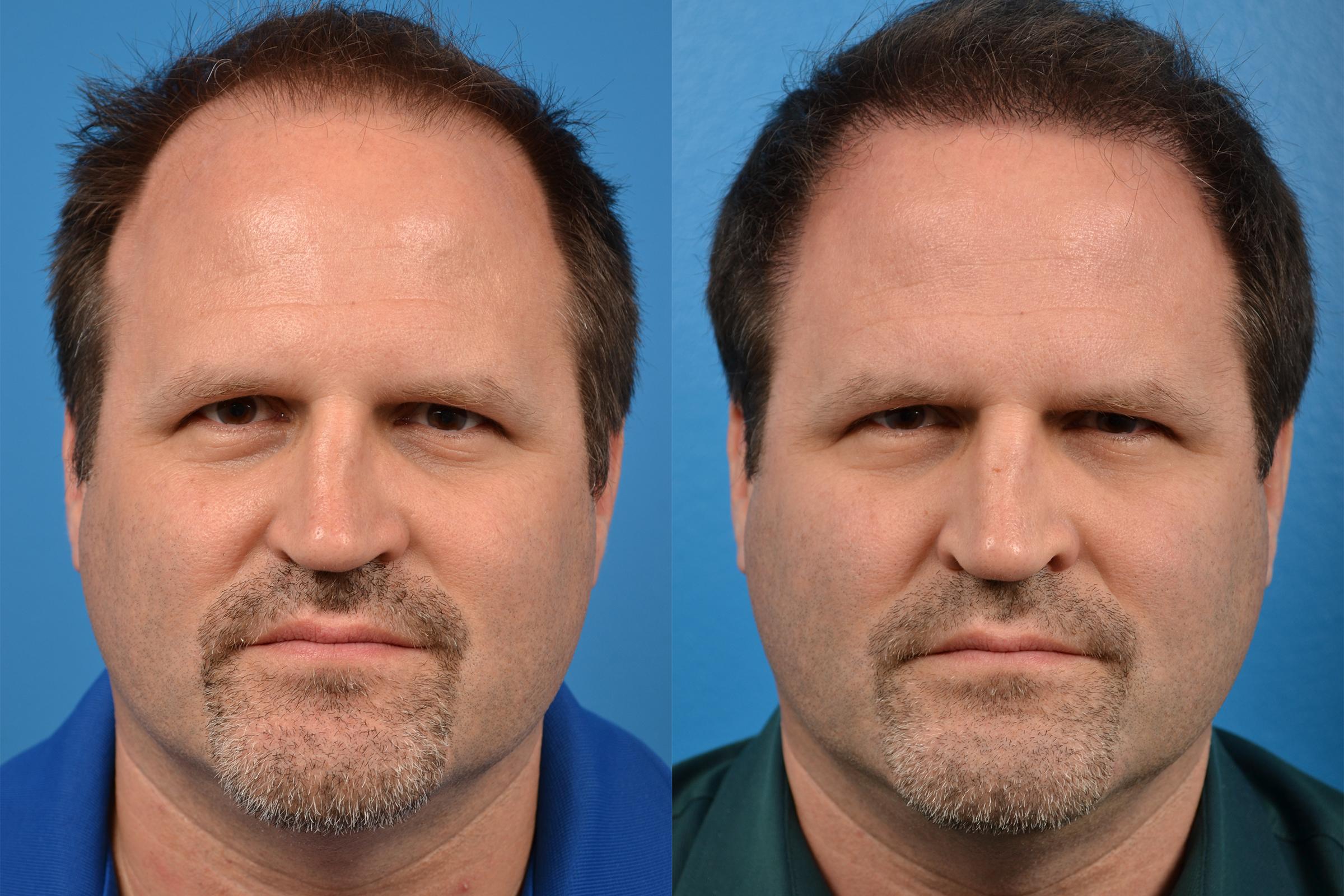 Hair Restoration Photos Melbourne, FL Patient 57533